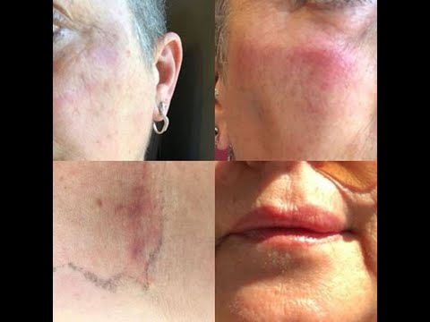 ''Guardate". Carolyn Smith mostra i segni del cancro dopo l'ultimo intervento | La prove del notizia