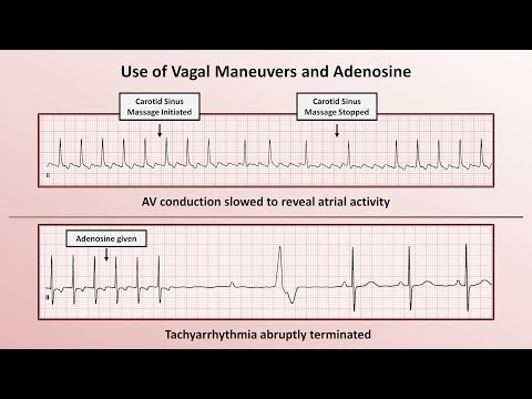 Intro to EKG Interpretation - How to Identify Any Tachyarrhythmia with 6 Easy Questions