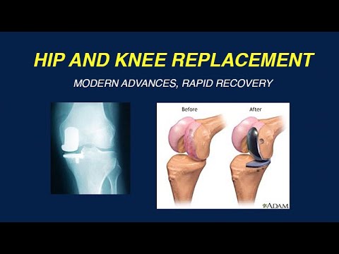 Modern Advances in Hip and Knee Replacement and Rapid Recovery - YouTube