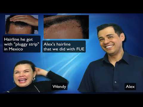 Patient testimonial 6 years after FUE repair of strip Dr. Lindsey | McLean | VA | Washington thumbnail