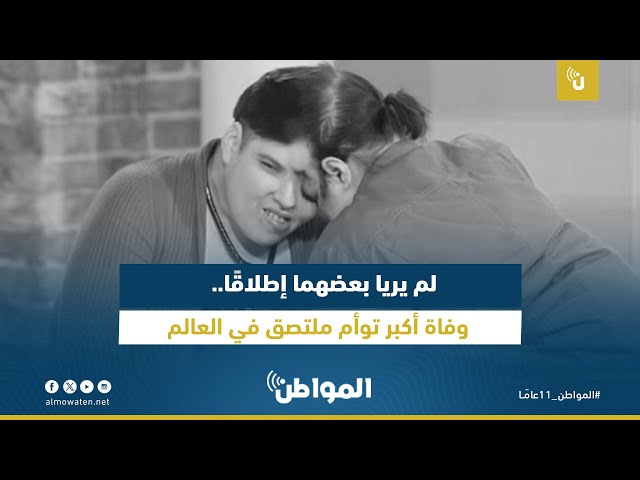 لم يريا بعضهما إطلاقًا.. وفاة أكبر توأم ملتصق في العالم