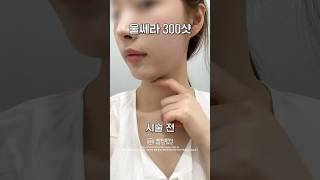 날씬한 사람이 울쎄라 받는다면?