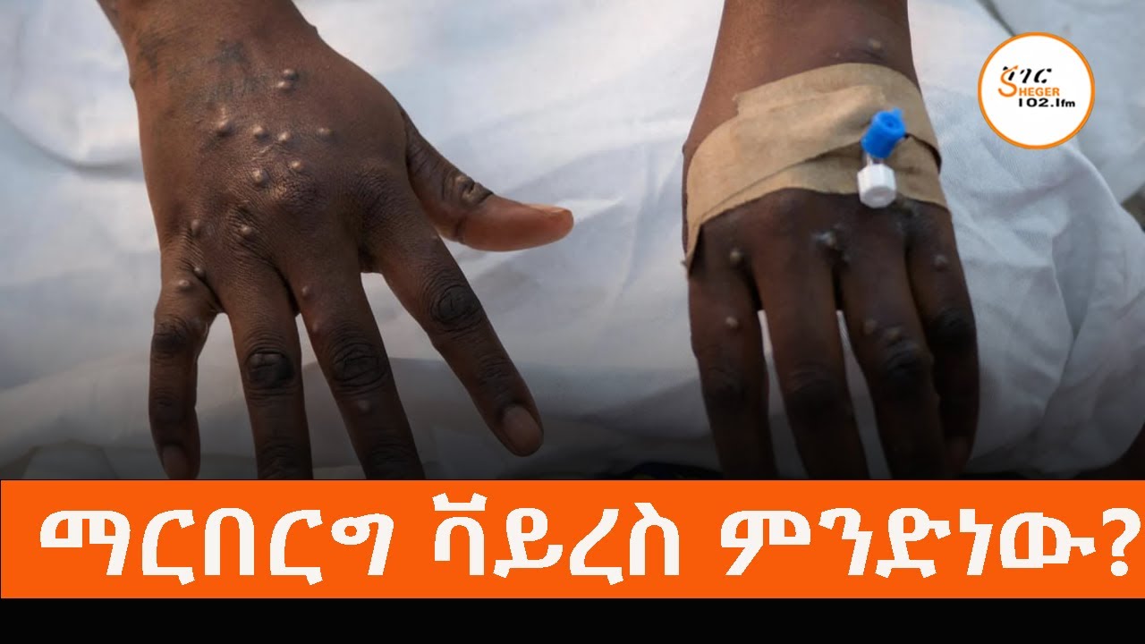 ሰሞኑን በደቡብ ኢትዮጵያ ክልል በጅንካ ከተማ የሄሞራጂክ ፊቨር በሽታ  የተያዙ ሰዎች