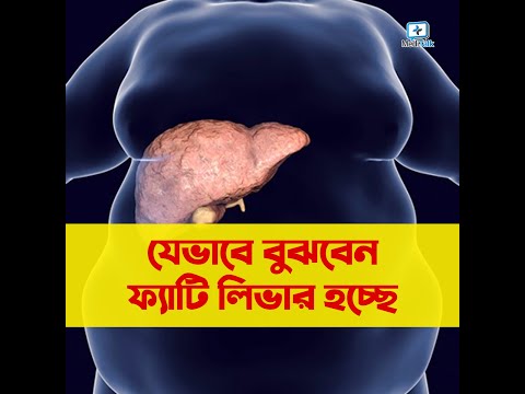 কি দেখে বুঝবেন ফ্যাটি লিভার আছে? Sings of Fatty Liver
