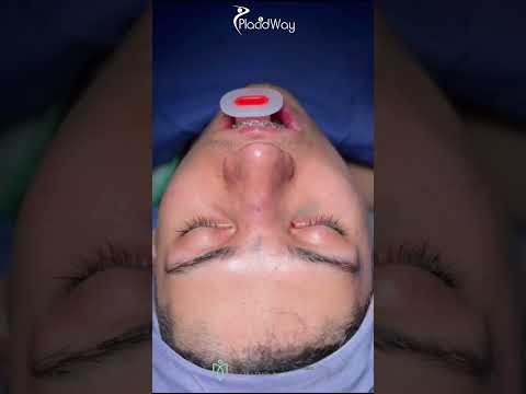 Elevate Your Profile: Before and After Nose Surgery in Mexicali, Mexico by Dr. Miguel Angel Fernandez