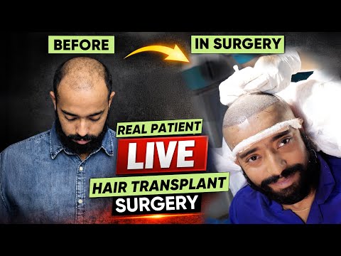 Hair Transplant in Kerala (HX-JHYU)  | Best Results & Cost of Hair Transplant in Kerala
