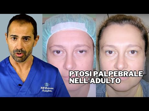 Eczema su un capezzolo quando allattamento al seno Dove con successo trattano risposte di psoriasi