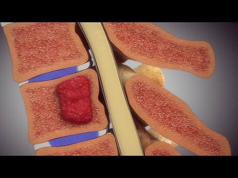 Spine Injury Animation with Hemangioma