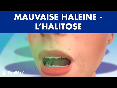 Mauvaise haleine – L’halitose ©