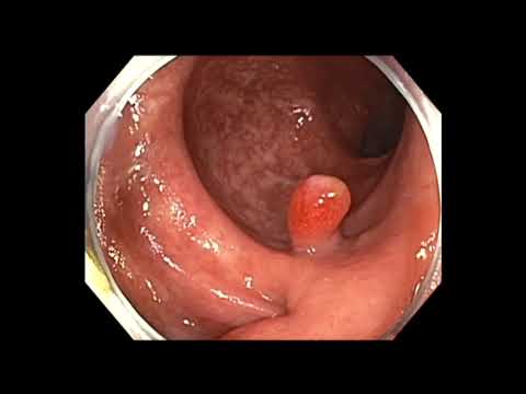 Colonoscopia - pólipos inflamatorios del intestino grueso