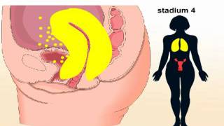 Baarmoederkanker - symptomen en behandeling van baarmoederkanker
