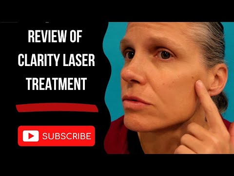 Clarity Laser Treatment Review