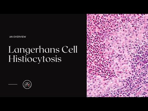 What is Langerhans Cell Histiocytosis?