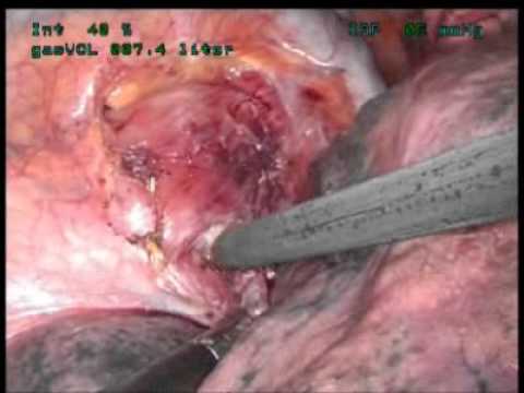 Resección toracoscópica de divertículo por tracción esofágico