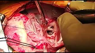 INTRA OPERATIVE SCIMITAR SYNDROME