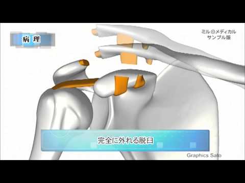 脱臼とは何か、原因、症状、治療方法