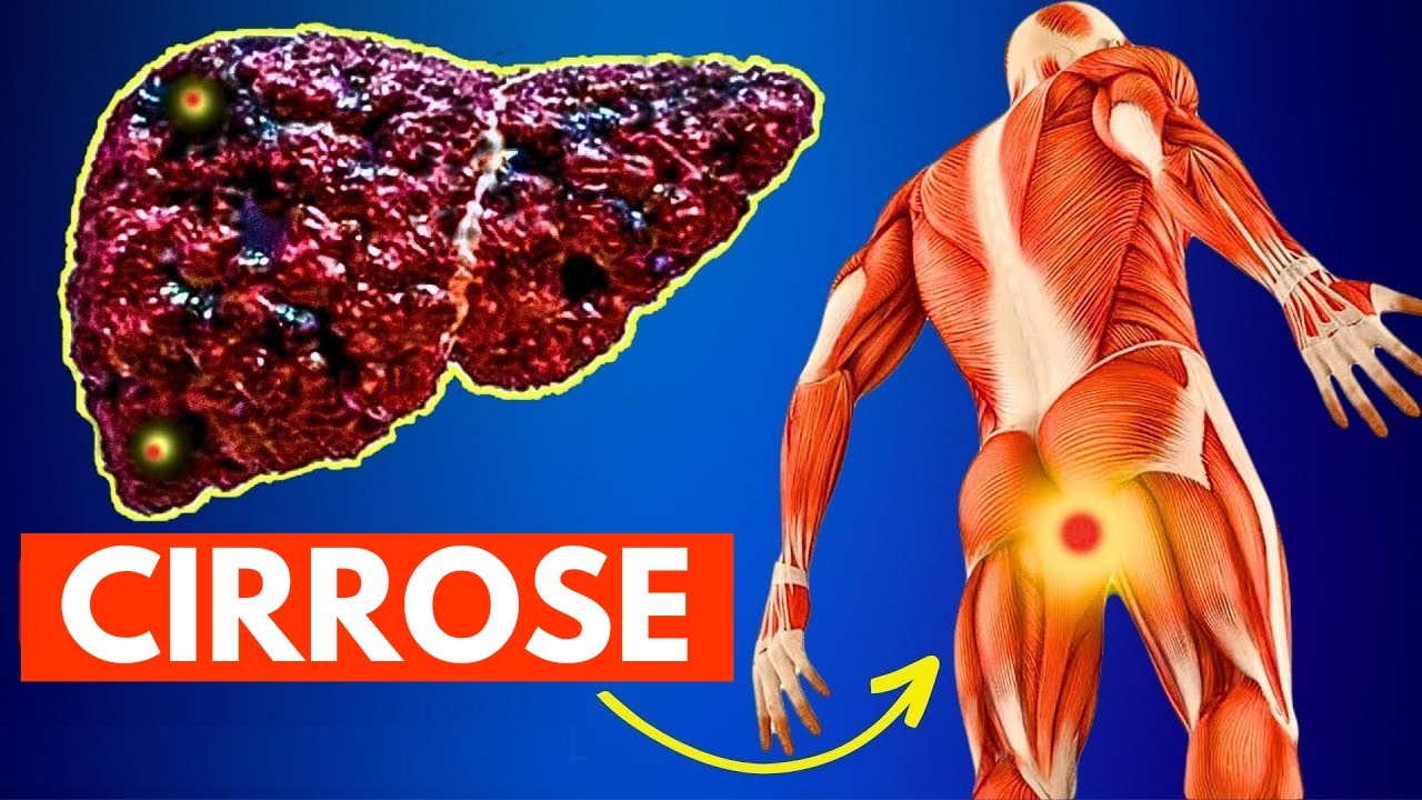 12 Primeiros Sinais de CIRROSE Hepática | O FÍGADO ESTÁ MORRENDO!