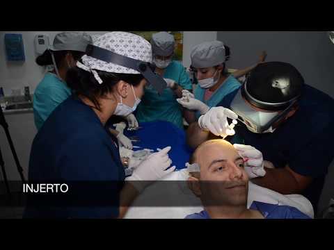 ¿Cómo es un INJERTO CAPILAR? #HairIn1Day