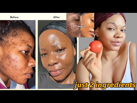 How I used tomato to remove Darkspots,Acne and Hyperpigmentation  #acne #skincare #diy