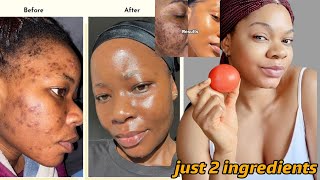 Download lagu How I used tomato to remove Darkspots,Acne and Hyperpigmentation  #acne #skincare #diy mp3