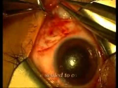 Fornix Reconstruction for Late Stage Chemical Burn Surgical 2 Video (OSREF) 