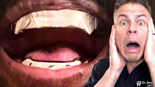 Did Kanye West REALLY Spend $850,000 To Replace His Teeth!
