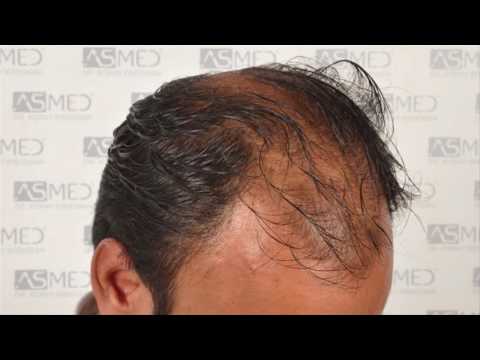 Manual FUE Hair Transplant Before & After, 5006 Grafts Result - ASMED - Dr. Koray Erdogan