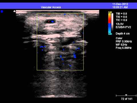 Ultrasound of Posterior Tibial Perforator