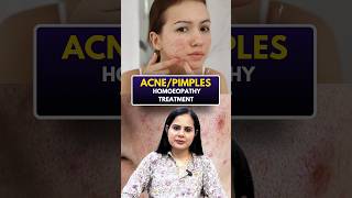 Download lagu Homeopathy Treatment For Acne Pimples #acne #pimples #homeopathy #skincare #shorts mp3