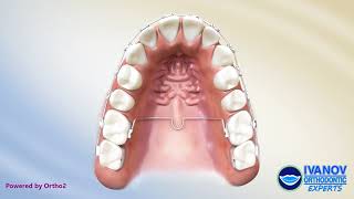 Trans Palatal Arch TPA