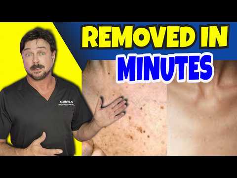 Eradicate Dark Skin Marks And Spots In 2 Minutes