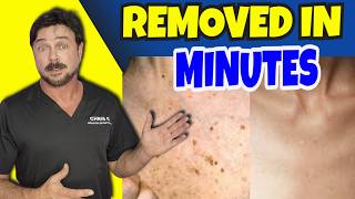 Eradicate Dark Skin Marks And Spots In 2 Minutes