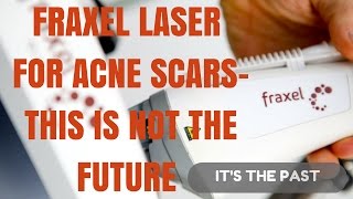 How to treat acne scars- NOT with Fraxel Laser