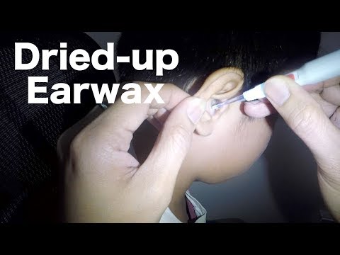 School Boy's Ear Cleaning of Dried-Up Earwax
