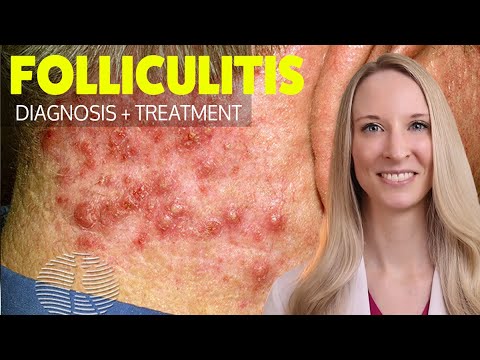 This is NOT Acne!  Folliculitis - self care and treatment