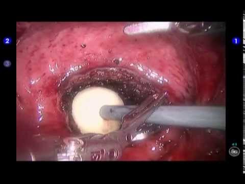 Robotic Simple Prostatectomy Using a Transverse Bladder Incision