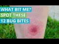 What Bit Me? Spot These 12 Bug Bites