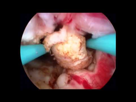 Prostata adenosis Chronische Prostatitis Behandlung Antibiotika