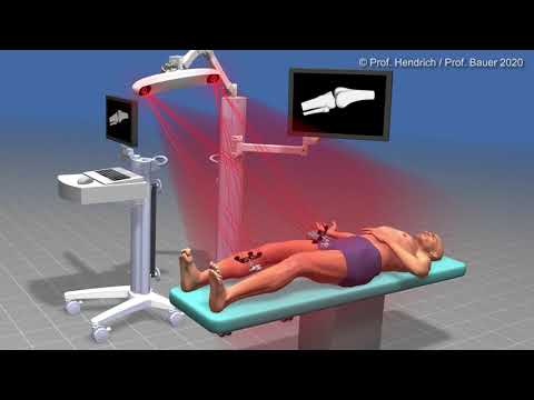 MAKOplasty®: hochpräzise, robotergestützte Knie-Endoprothetik