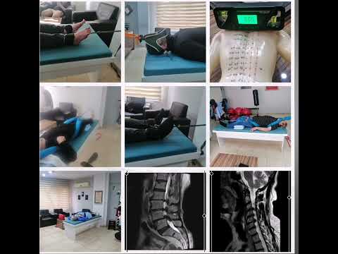 Skolyoz Kifoz Tedavisi