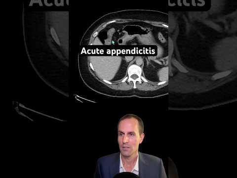 Abdominal CT Tutorials - Acute appendicitis