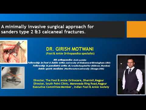 Minimal invasive sinus tarsi approach for calcaneal fracture by Dr. Girish Motwani