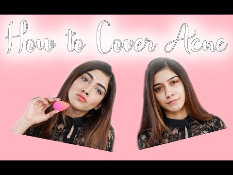 HOW TO COVER ACNE SPOTS!!!