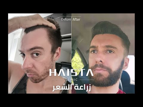نتائج عمليات زراعة الشعر واللحية في تركيا | HAISTA CLINIC