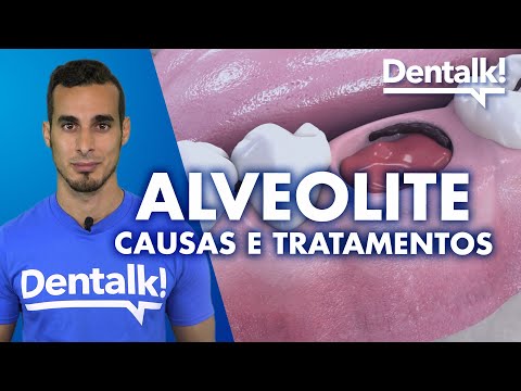 Vídeo: Alveolite: tratamento, síntomas e causas