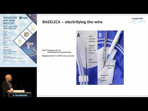 N. Van Mieghem  | Mechanisms of coronary obstruction during and after TAVR: prediction, preventio...