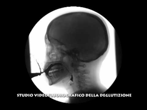 Mal di schiena complesso coccodrillo Ciò effusione dellarticolazione del polso