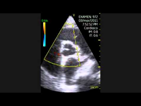 Myopathy Of The Heart Due To Thyroid Insufficiency 