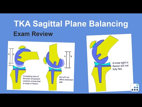 TKA Sagittal Plane Balancing Exam Review - Ron Delanois, MD