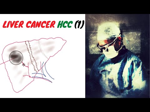 LIVER CANCER; HCC (1)
